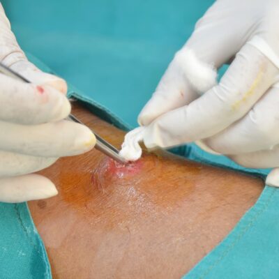 Proteccion y fijación de heridas