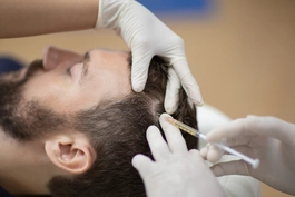 Alopecia