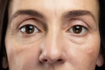 Detalle de la mirada de una mujer mostrando la zona de las ojeras para tratamientos de medicina estética facial.